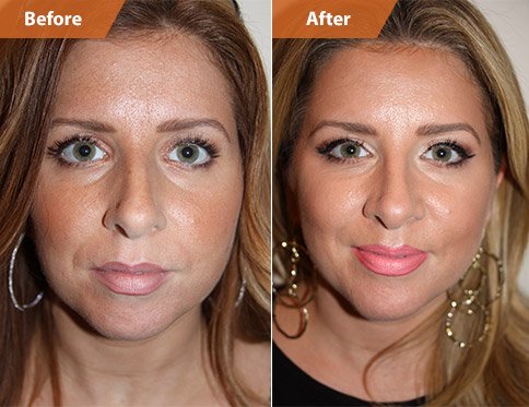 Female Face, Before and After Rhinoplasty Treatment. This 26-year-old female patient had a drooping and long nose, side view
