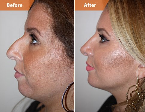 Woman's face, Before and After Rhinoplasty Treatment, front view, patient 1