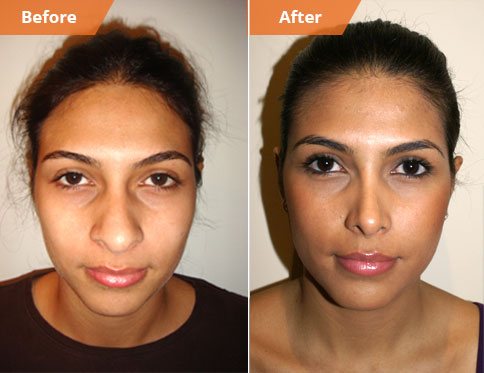 Patient before and after rhinoplasty