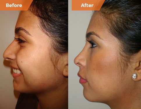 Female face, Before and After rhinoplasty treatment, side view, patient 1