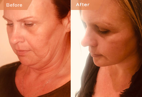 photos Female patient  Before and After Facelift