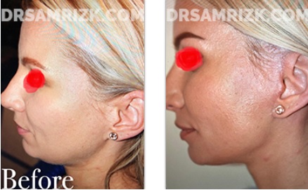 Female Face, Before and After Rhinoplasty Treatment. This 26-year-old female patient had a drooping and long nose, front view