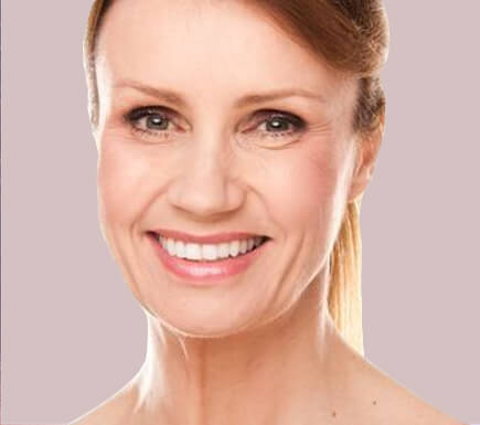 Other Procedures: Facelift / Necklift