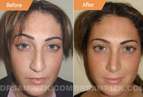 Patient before and after rhinoplasty