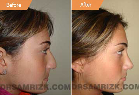 Patient before and after rhinoplasty side view