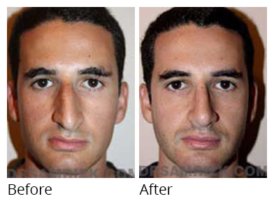 Nose Surgery - Patient before after