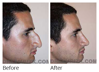 Patient before after Nose Surgery
