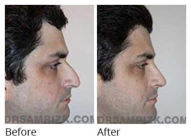 Male before after Rhinoplasty
