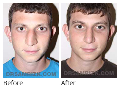 Patient before after Septorhinoplasty - photo