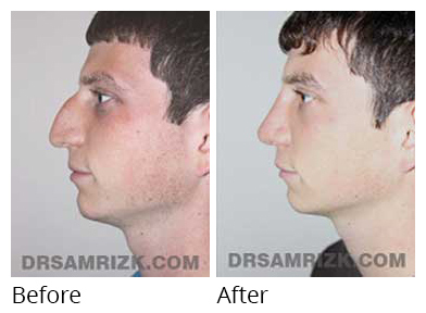 Patient before after Septorhinoplasty - img