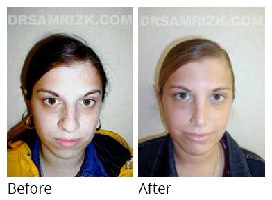 Woman's face, before and after Chin and cheek treatment, front view, patient 1