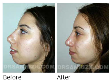 Woman's face, before and after Chin and cheek treatment, side view, patient 2