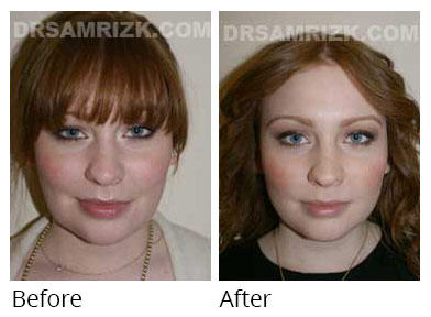 Woman's face, before and after Chin and cheek treatment, front view, patient 3