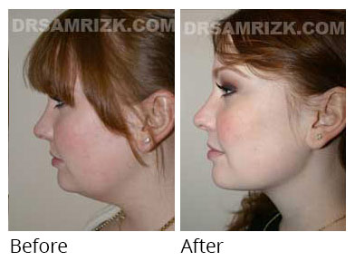 Woman's face, before and after Chin and cheek treatment, side view, patient 3