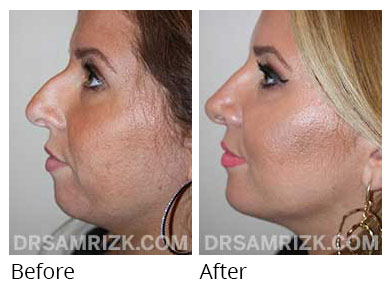Woman's face, before and after Chin and cheek treatment, side view, patient 4