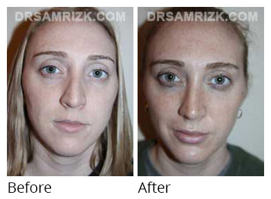 Woman's face, before and after Chin and cheek treatment, front view, patient 5