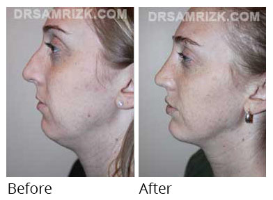 Woman's face, before and after Chin and cheek treatment, side view, patient 5