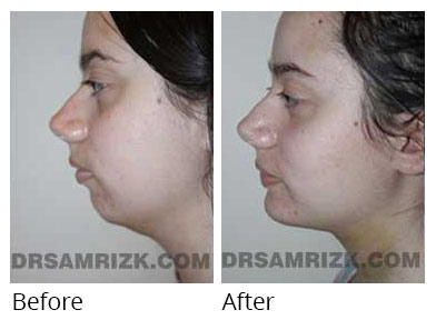Woman's face, before and after Chin and cheek treatment, side view, patient 6