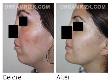 Woman's face, before and after Chin and cheek treatment, side view, patient 7