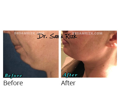 Woman's face, before and after Chin and cheek treatment, side view, patient 10