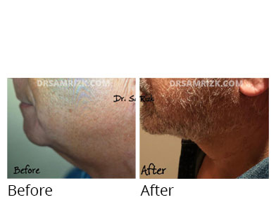 Male face, before and after Chin and cheek treatment, side view, patient 9
