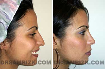 Female Face, Before and After Rhinoplasty Treatment. This 26-year-old female patient had a drooping and long nose, front view