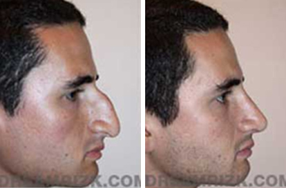 Female Face, Before and After Rhinoplasty Treatment. This 26-year-old female patient had a drooping and long nose, front view