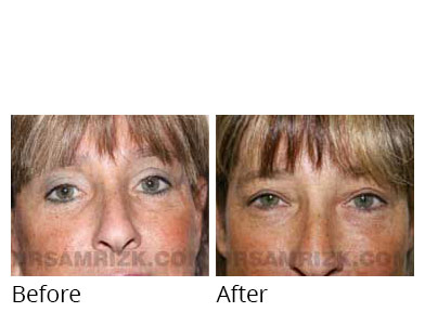 Female face, before and after Eyelids surgery, front view, patient 1