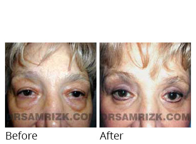 Female face, before and after Eyelids surgery, front view, patient 2