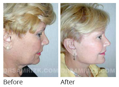 Female face, before and after Eyelids surgery, side view, patient 5