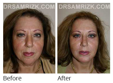 Female face, before and after Eyelids surgery, front view, patient 6
