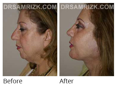 Female face, before and after Eyelids surgery, side view, patient 6