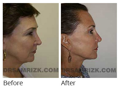 Female face, before and after Eyelids surgery, side view, patient 7