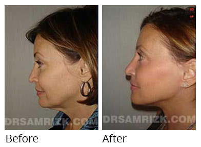 Female face, before and after Eyelids surgery, side view, patient 8