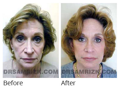 Female face, before and after Eyelids surgery, front view, patient 10