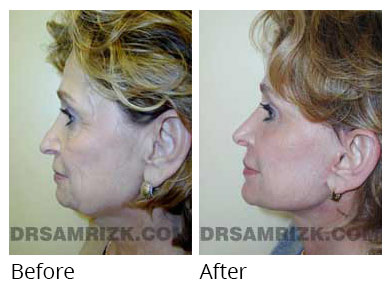 Female face, before and after Eyelids surgery, side view, patient 10