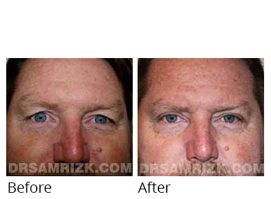 Male face, before and after Eyelids surgery, front view, patient 11