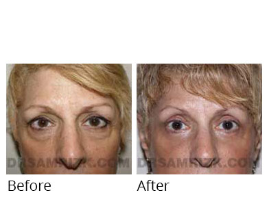 Female face, before and after Eyelids surgery, front view, patient 12
