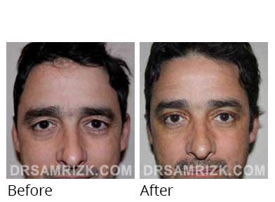 Male face, before and after Eyelids surgery, front view, patient 15