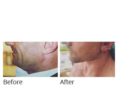Male face, before and after Facelift and necklift treatment, side view, patient 1