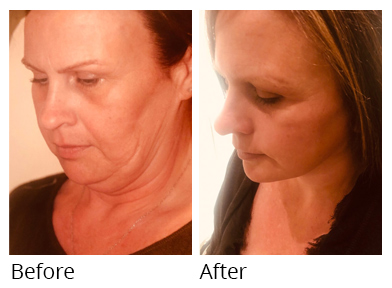 Female face, before and after Facelift and necklift treatment, oblique view, patient 2
