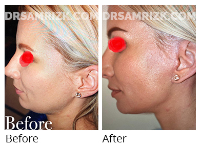 Female face, before and after Facelift and necklift treatment, side view, patient 3