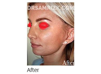 Female face, after Facelift and necklift treatment, oblique view, patient 3