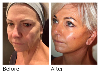 Female face, before and after Facelift and necklift treatment, oblique view, patient 5