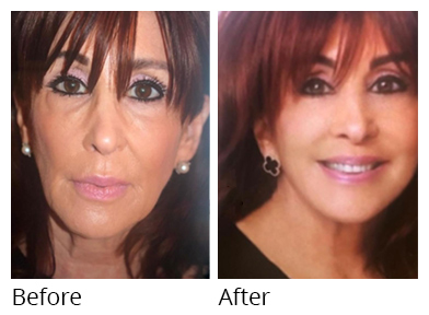 Female face, before and after Facelift and necklift treatment, front view, patient 6