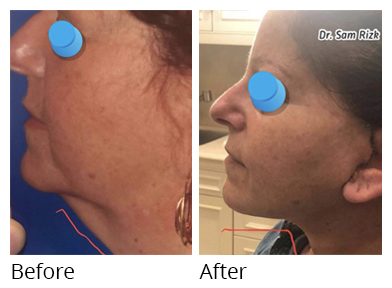 Female face, before and after Facelift and necklift treatment, side view, patient 10