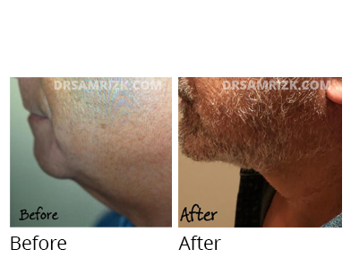 Male face, before and after Facelift and necklift treatment, side view, patient 12