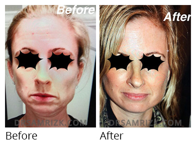 Female face, before and after Facelift and necklift treatment, front view, patient 13
