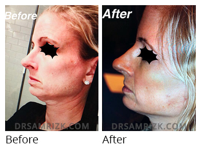 Female face, before and after Facelift and necklift treatment, side view, patient 13