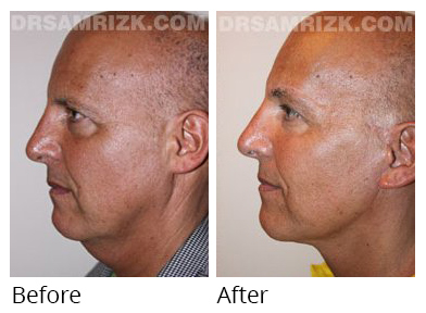 Male face, before and after Facelift and necklift treatment, side view, patient 14